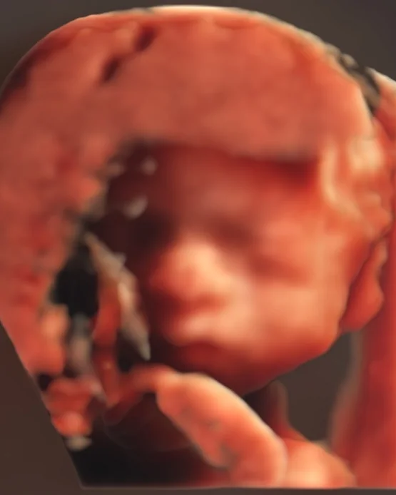Imagen de ultrasonido obstétrico 3D del rostro de un bebé